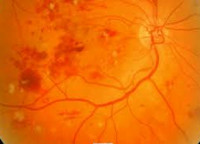 diabetic retinopathy2