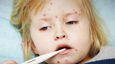 meningococcal infection